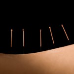 acupuncture